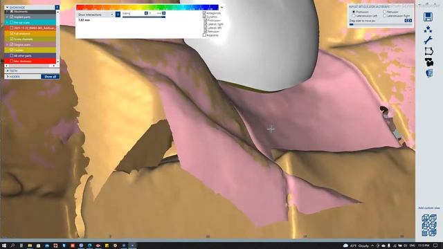 IMPLANT SUPPORTED CROWN SCREW RETAINED смотреть онлайн