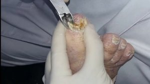 Педикюр страшных грибковых ногтей