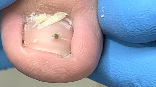 Trimming Ingrown Nails For Patients, Deep Cleaning【Xue Yidao】