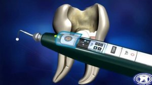 Пломбирование корневых каналов