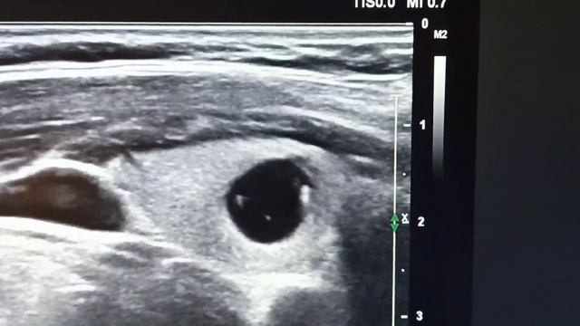 узел в щитовидной железе, node in the thyroid gland смотреть онлайн