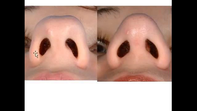 The Perfect Nose – Rhinoplasty in San Francisco. Ринопластика идеальный нос. смотреть онлайн