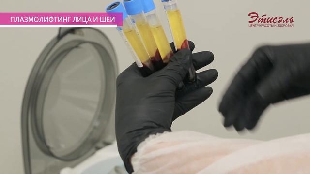Плазмолифтинг лица и шеи, плазмотерапия для волос. смотреть онлайн