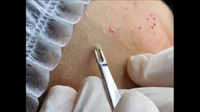 Remoção De Cravo 2021 - Pimple Popping 2021 -Blackhead Removal  EP0017