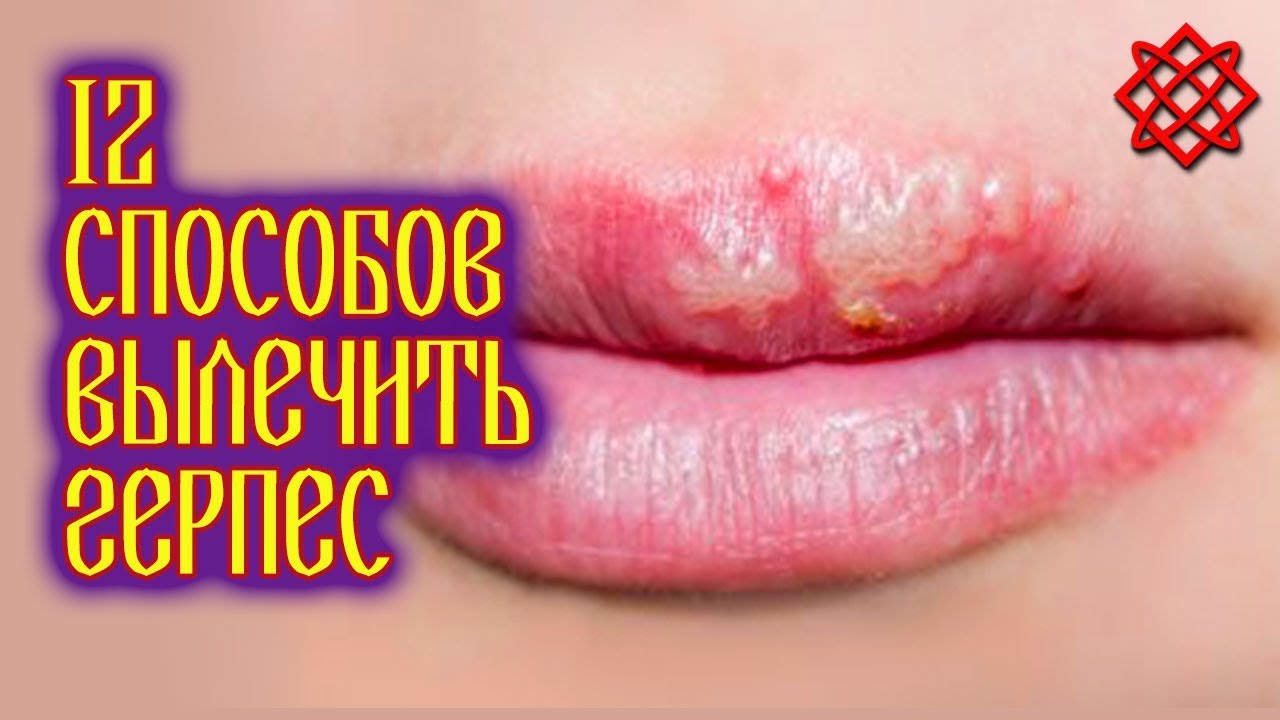КАК ЛЕЧИТЬ ГЕРПЕС НА ГУБАХ. Как Быстро Избавиться от Герпеса.mp4