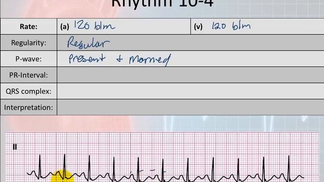 Basic Electrophysiology, part 6 - Sinus Node Rhythms смотреть онлайн