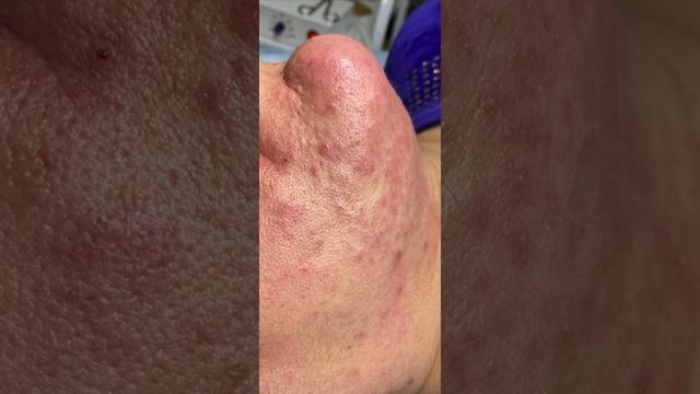 Электроэпиляция смотреть онлайн