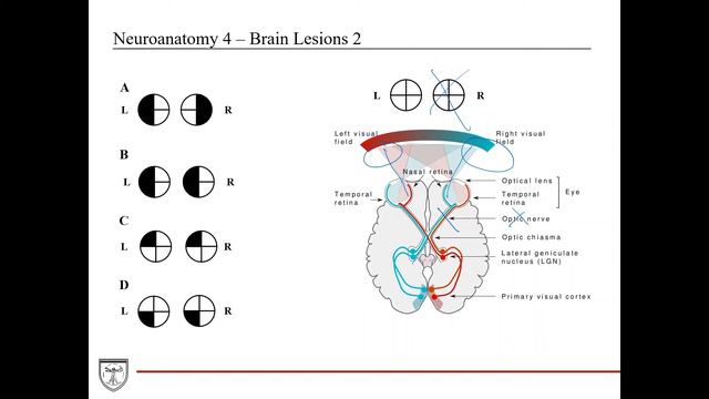 Visual Field Defects and Brain Tumors Case [#DaVinciCases Neuroanatomy 4] смотреть онлайн