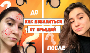 КАК ИЗБАВИТЬСЯ ОТ ПРЫЩЕЙ.MOV