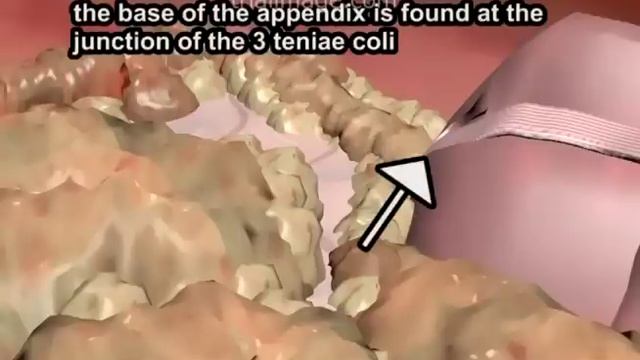 Laparoscopic Appendectomy - Animation by Cal Shipley, M.D. смотреть онлайн