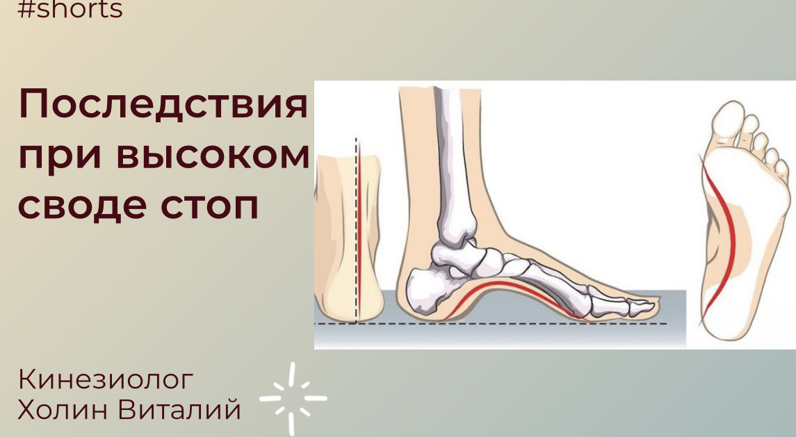 Последствия при высоком своде стоп смотреть онлайн