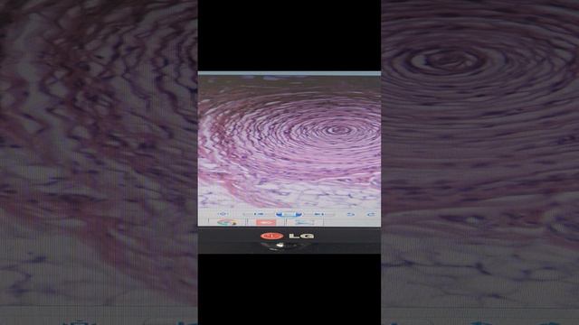 Полидактилия смотреть онлайн