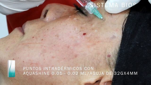 Bioestimulación en 5D con DERMAHEAL HSR y PTx, AQUASHINE, NATURAL B y REVOFIL смотреть онлайн