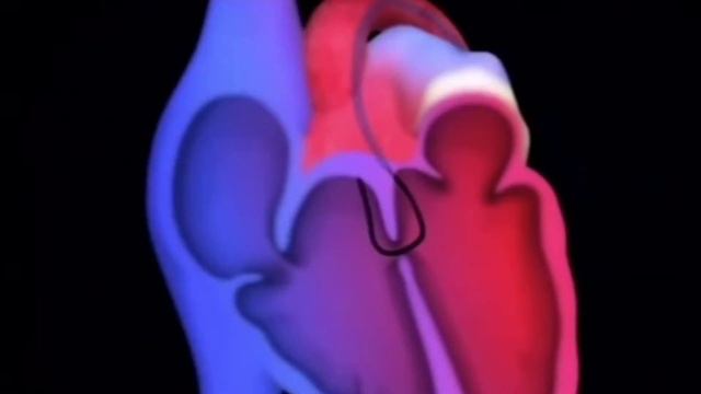 Device Closure - чрескожное закрытие дефекта межпредсердной перегородки смотреть онлайн