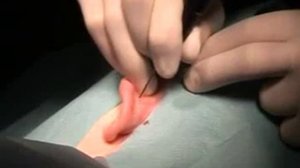 Лазерная пластика ушей