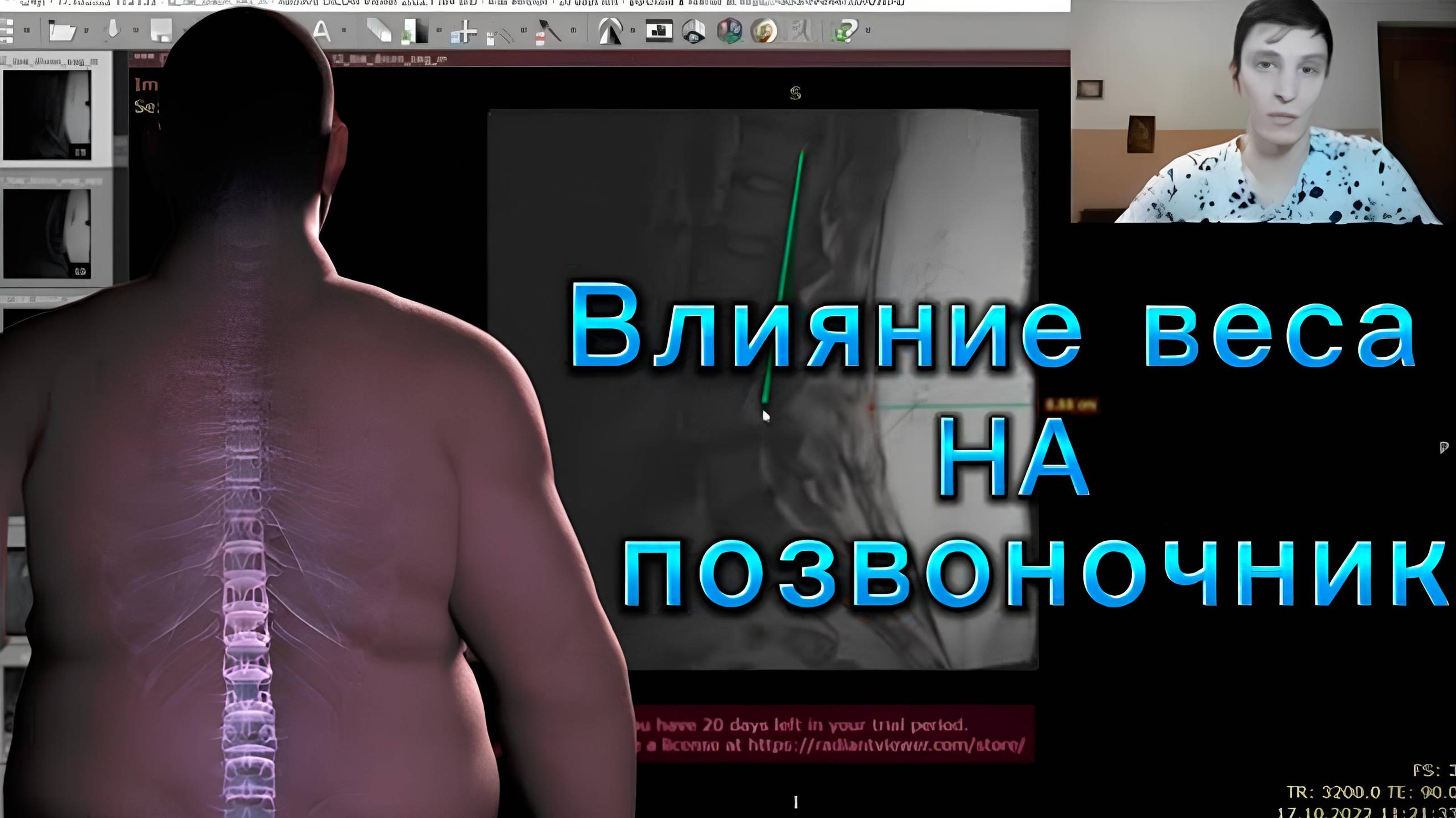 Как лишний вес влияет на здоровье позвоночника. Почему лишний вес может быть причина боли в пояснице смотреть онлайн