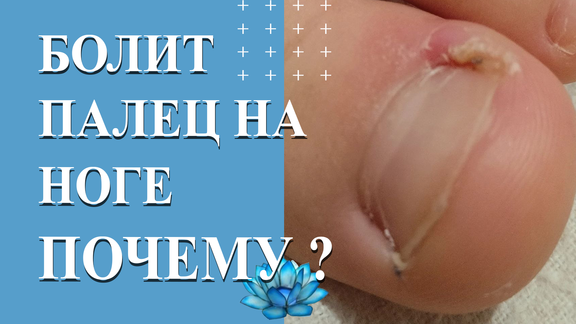 Вросший ноготь у ребёнка. Удаление вросшего ногтя. смотреть онлайн