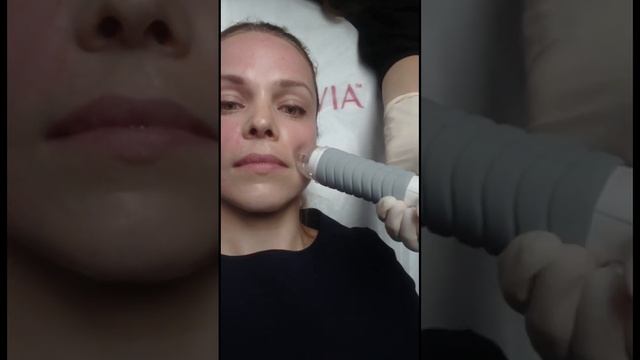 Игольчатый RF лифтинг на аппарате Vivace #лифтинглица #москва #косметология #рфлифтинг #vivace смотреть онлайн