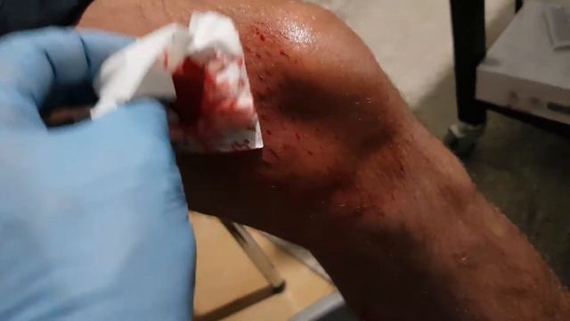 Хиджама на миниск hijama du ménisque meniscus hijama الحجامة смотреть онлайн
