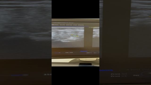 Выявили причину сеточек на ногах. Сосудистый чекап. Узи. Флеболог Москва смотреть онлайн