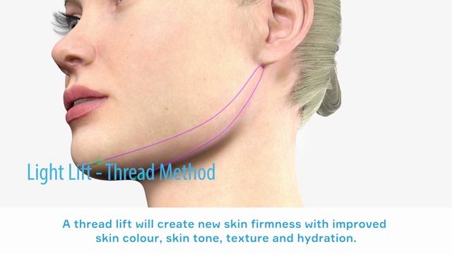 Aptos Thread Lifting Light Lift Needle Method смотреть онлайн