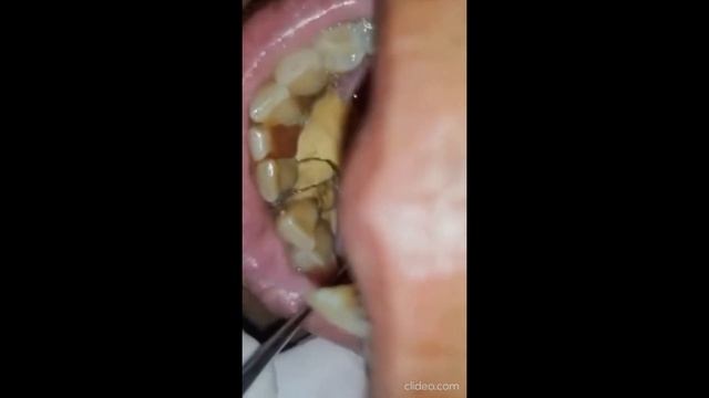 удаления зубного камня смотреть на ютуб _tartar removal watch on youtube смотреть онлайн