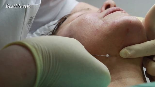 Процедура нити (1) смотреть онлайн