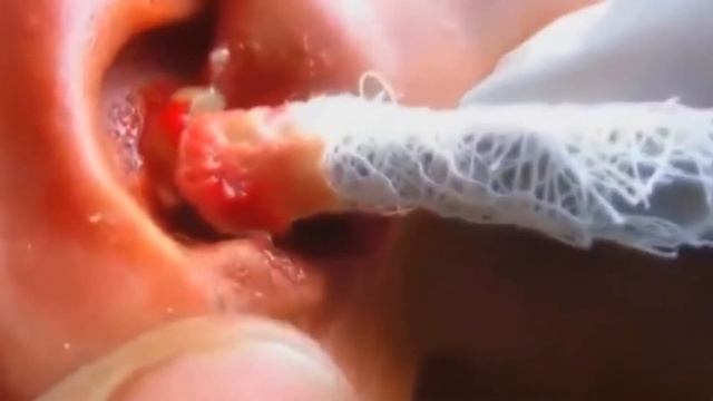 Выдавливание огромного прыща Squeezing big pimple в ухе смотреть онлайн