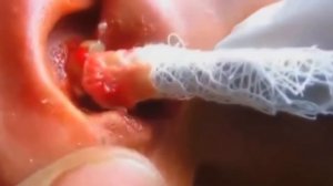 Выдавливание огромного прыща Squeezing big pimple в ухе