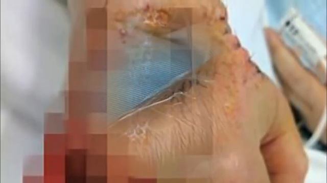 Mom Is Left Fighting For Her Life After Scratching Her Finger Whilst Cleaning Her New Home смотреть онлайн