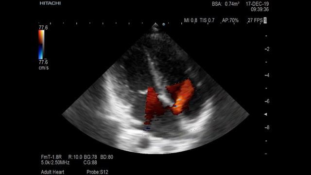 Дефект межпредсердной перегородки смотреть онлайн