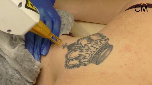 Центр косметологии Сан Медик Москва Китай Город |Лазерное удаление татуировок | Сан Медик смотреть онлайн