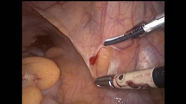 Laparoscopic Pelvis Lymphadenectomy / Лапароскопическая тазовая лимфаденэктомия слева смотреть онлайн