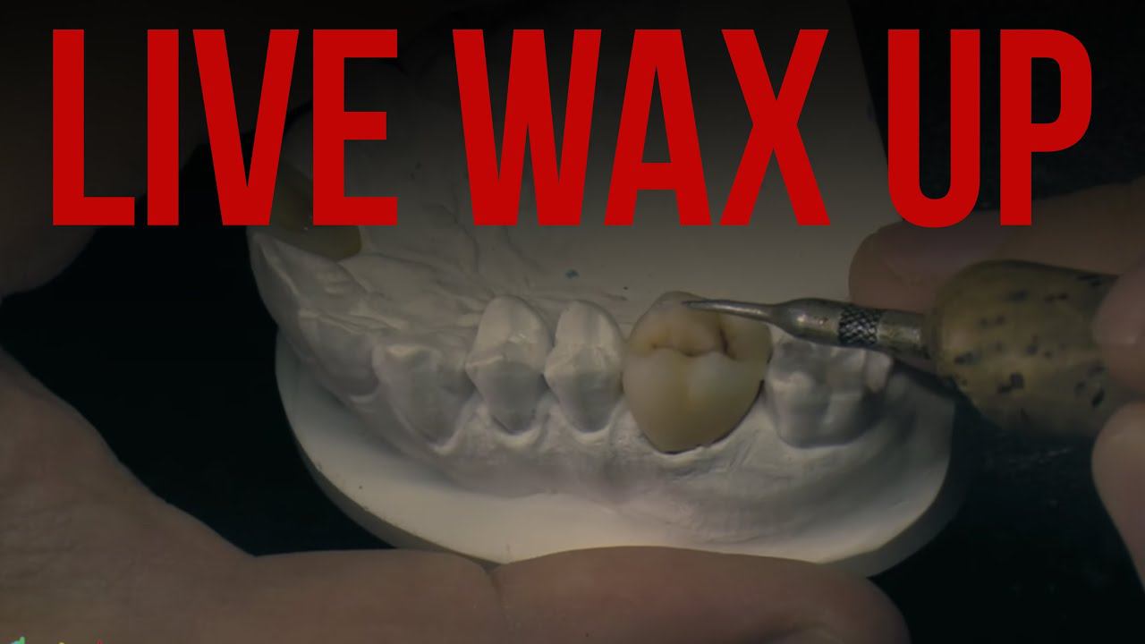 Live wax up. waxup modeling. Modeling tooth molar wax. Восковое моделирование смотреть онлайн