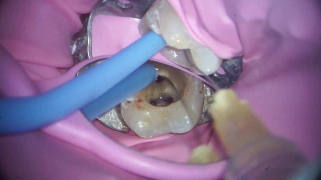 Preendobuildup | Activating irrigating solutions in endodontics | Decode endodontics | смотреть онлайн