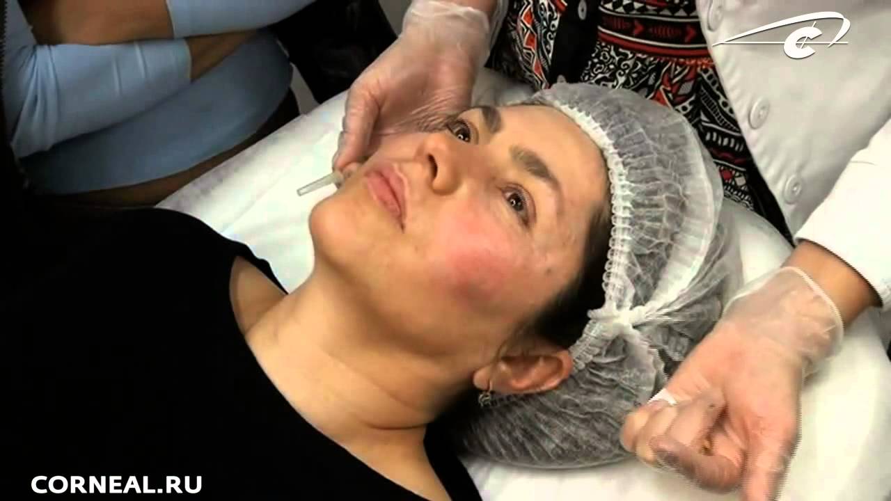 Линейная техника. Биоревитализация. Essel lab. смотреть онлайн