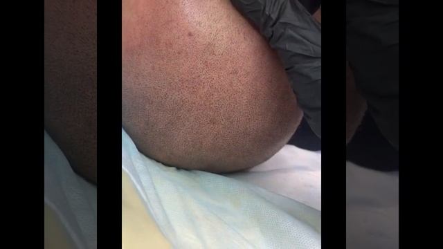 Трихопигментация до после. Здесь создаю разреженную переднюю линию роста волос. смотреть онлайн