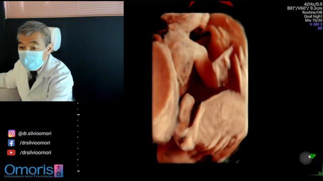 Mãe de 4 filhos faz uma ultrassonografia para descobrir sexo de gêmeos. смотреть онлайн