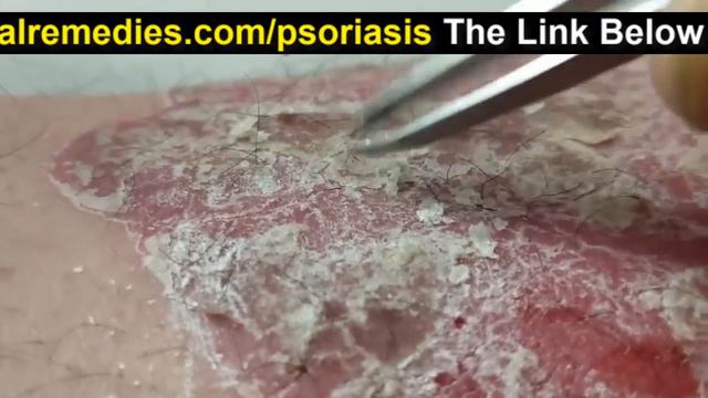Psoriasis : How To Treat (Cure, Get Rid Of, Remove) Psoriasis Naturally Permanently at Home смотреть онлайн