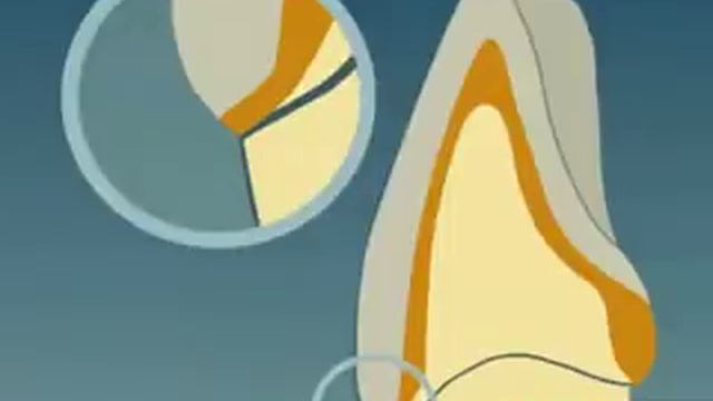 Изготовление металлокерамических коронок смотреть онлайн