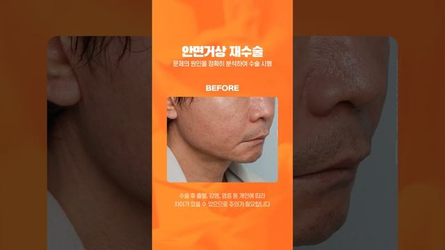 브이라인 작은 얼굴 안면거상 재수술 1개월 경과 후기 #shorts смотреть онлайн