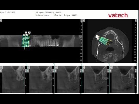 Генератор отчетов в программе Ez3D-i v5.2 от VATECH смотреть онлайн