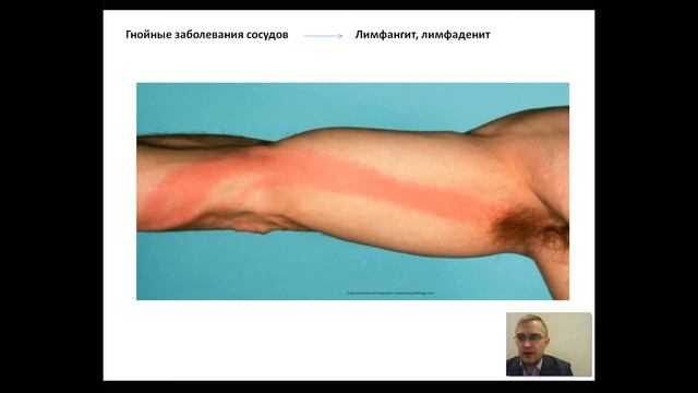 Гнойные заболевания железистых органов, сосудов, кисти смотреть онлайн