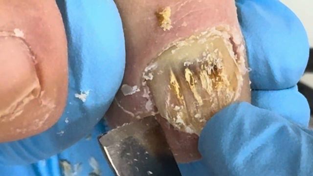 Clean foot calluses and onychomycosis and get a professional pedicure смотреть онлайн