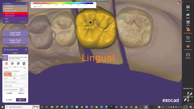 crown design in exocad 3.1 смотреть онлайн