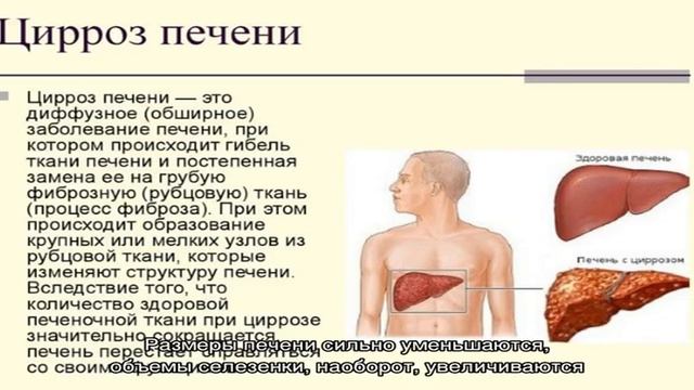 Четыре стадии цирроза печени смотреть онлайн