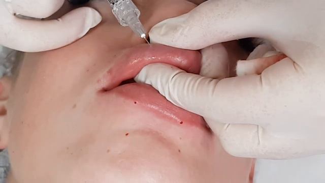 Как вывернуть верхнюю губу? Техника контурная пластика / филлер смотреть онлайн