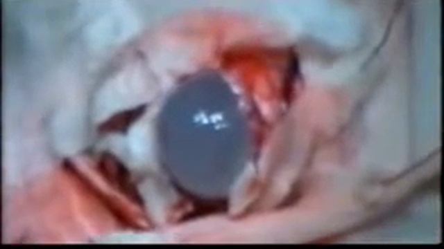 киста десны/ киста ясен смотреть онлайн