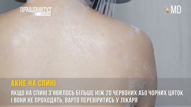 АКНЕ НА СПИНІ І MD Expert №95 смотреть онлайн