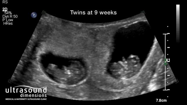 Scan of the Week: Twins at 9 weeks gestation! смотреть онлайн